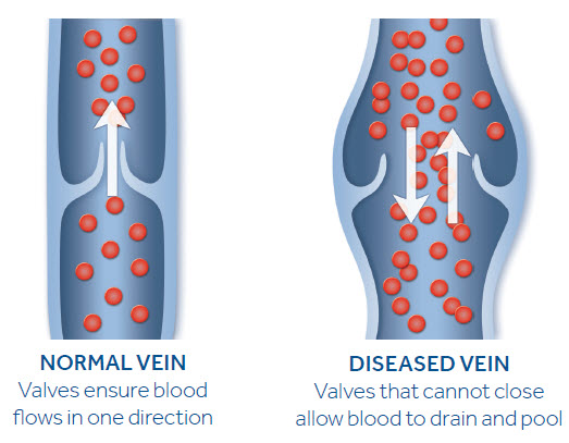 Normal veins ensure blood flows in one direction. Diseased veins that cannot close allow blood to drain and pool.